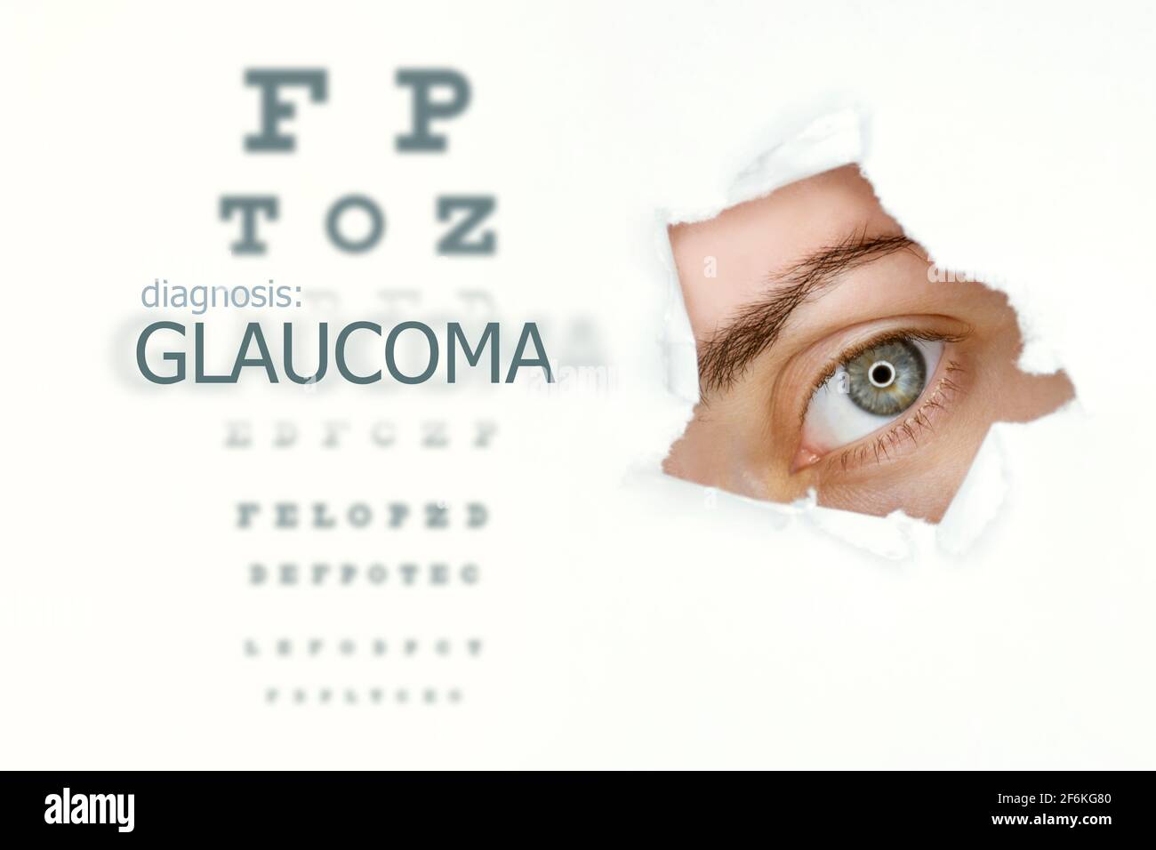 Woman`s eye looking trough teared hole in paper, eye test and word Glaucoma on left. Eye disease concept template. Isolated white background. Stock Photo